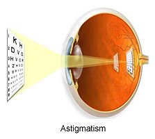 Astigmatism