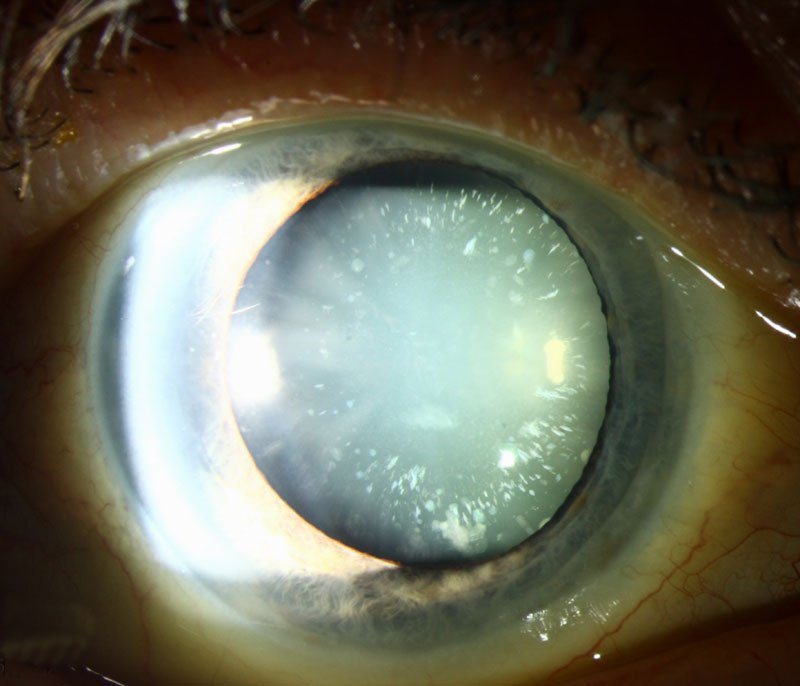 Cataract