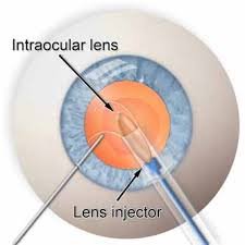 Intraocular Lenses