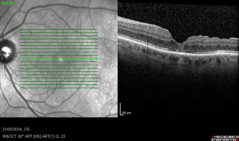 Macular Hole after Surgery